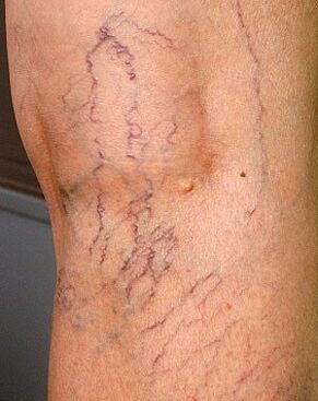 manifestaciones de venas varicosas en las piernas