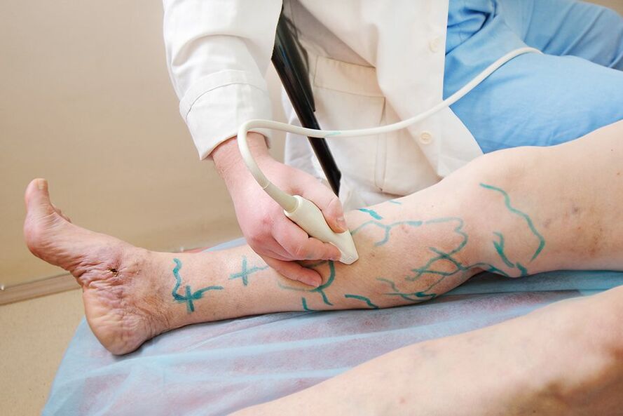 Preparación para miniflebectomía marcado en las perforaciones de la parte inferior de la pierna, realización de ultrasonido